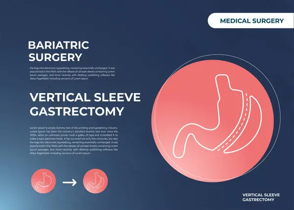 Laparoszkópos Hüvely Gastrectomia Vertikális Gastrectomia Testsúlycsökkentő Műtét Vektor Gyomorszűkítő Műtét — Stock Vector