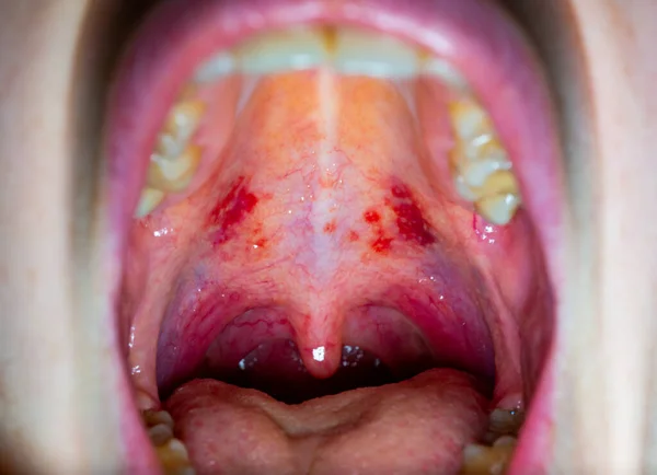 Inflamed throat of a sick person, red blood vessels of the upper wall of the oral cavity