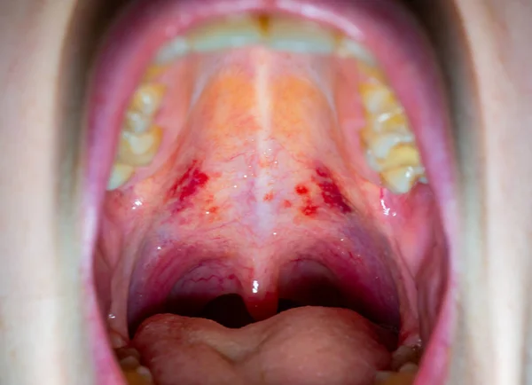 Inflamed throat of a sick person, red blood vessels of the upper wall of the oral cavity
