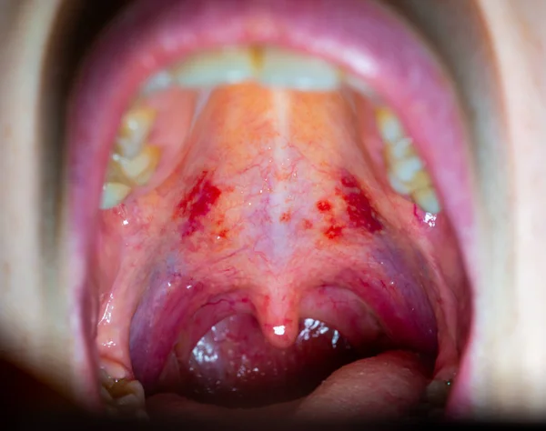 Inflamed throat of a sick person, red blood vessels of the upper wall of the oral cavity