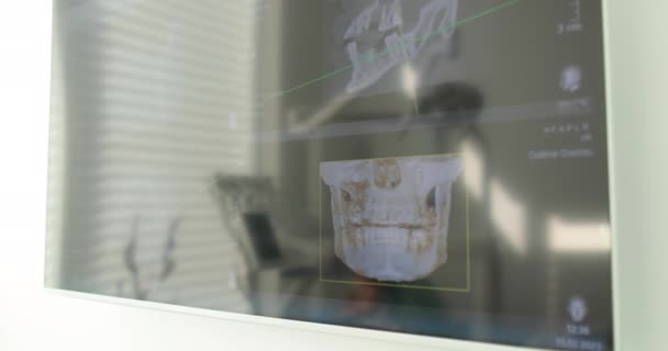 Radiografías Las Mandíbulas Pantalla Del Consultorio Dental — Vídeos de Stock