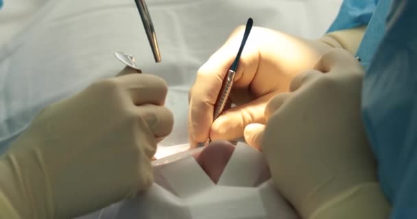 Tandheelkundige Behandeling Close Een Tandarts Voert Een Tandheelkundige Ingreep Tandartsenhanden — Stockvideo