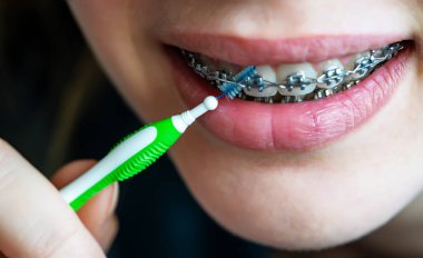 Diş fırçasıyla diş tellerini temizleyin.