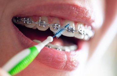 Diş fırçasıyla diş tellerini temizleyin.