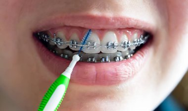 Diş fırçasıyla diş tellerini temizleyin.