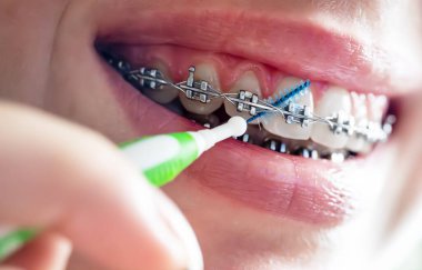 Diş fırçasıyla diş tellerini temizleyin.