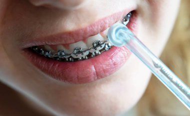 Diş ipi ile temizlenen diş tellerini kapat.