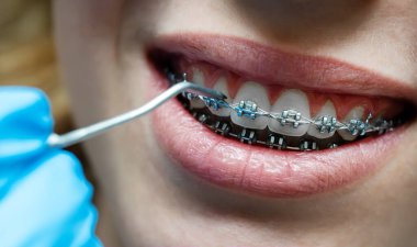 Diş aygıtı ile diş tellerini kontrol eden ortodontiste yakınlaş.