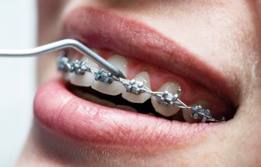 Diş aygıtı ile diş tellerini kontrol eden ortodontiste yakınlaş.