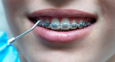 Diş aygıtı ile diş tellerini kontrol eden ortodontiste yakınlaş.