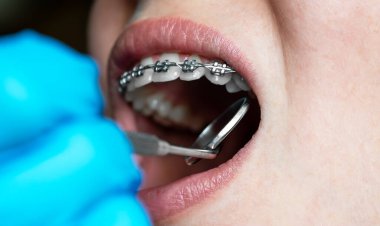 Diş aynası ve araç ile diş tellerini kontrol eden ortodontiste yakın çekim.