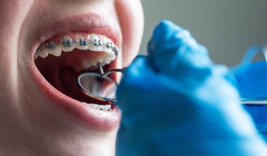 Diş aynası ve araç ile diş tellerini kontrol eden ortodontiste yakın çekim.