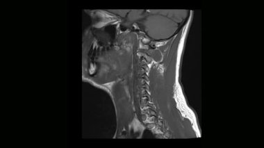 Tıbbi tomografi MRI tarama osteochondrosis bir adamla servikal omurga hesaplanan.