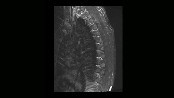 Tomografii Komputerowej Medycznych Mri Piersiowego Kręgosłupa Człowieka Osteochondrozy — Wideo stockowe