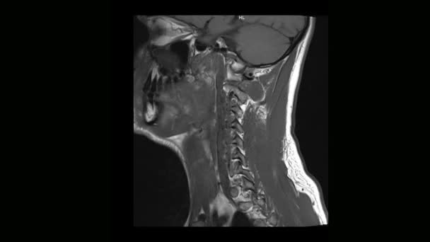 Datortomografi Medicinsk Mrt Halsryggen Man Med Osteokondros — Stockvideo