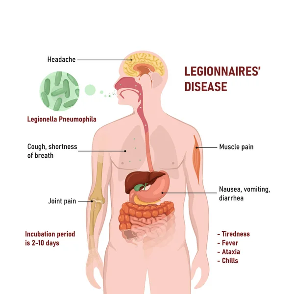 Legionärssjuka Eller Legionärssjuka Eller Legionärssjuka Tecken Och Symtom Form Atypisk — Stock vektor