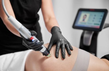 Kadın derisindeki gerilme izlerini temizlerken, mikro radyasyon cihazı kullanarak kozmetolojistin etrafını kapatın. Güzellik salonunda deri sıkılaştırma ameliyatı olan bir kadın. Donanım kozmetoloji kavramı.