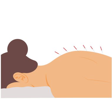 Akupunktur iğneleri olan kadın, vektör illüstrasyonu.