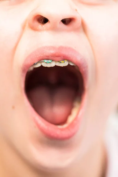 Close Mouth Girl Rainbow Braces — Stock Photo, Image
