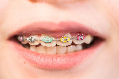 Close-up of the mouth of a girl with rainbow braces. clipart