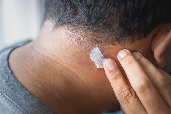 Dark-skinned Asian men apply skin treatment suffer from scalp dermatitis due to moisture-causing fungi. fungal itching. skin diseases-allergies, psoriasis, eczema, dermatitis.