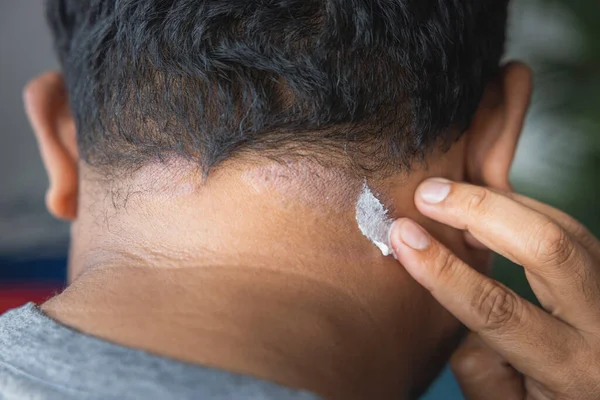 Dark-skinned Asian men apply skin treatment suffer from scalp dermatitis due to moisture-causing fungi. fungal itching. skin diseases-allergies, psoriasis, eczema, dermatitis.