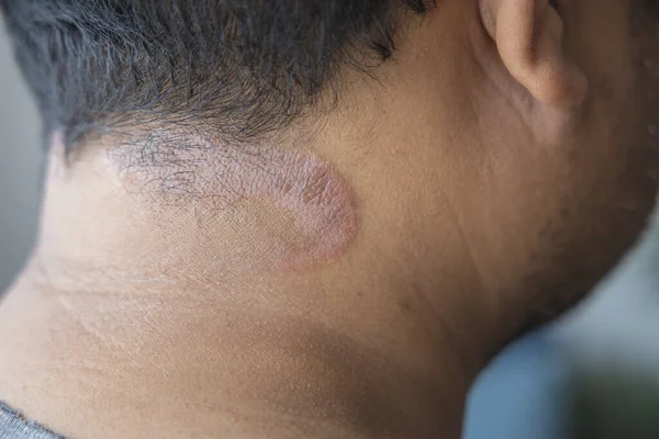 Dark-skinned Asian men suffer from scalp dermatitis due to moisture-causing fungi. fungal itching. skin diseases-allergies, psoriasis, eczema, dermatitis.