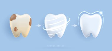 Diş temizleme ve diş beyazlatma seti. Temiz ve kirli dişlerin karşılaştırılması. Diş sağlığı ve diş hekimliği için ağız temizliği posteri. Muayene dişleri, beyazlatma ve onarım. vektör tasarımı.