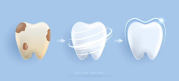 Set of dental cleaning and whitening teeth concept. comparison of clean and dirty tooth. dental health and oral hygiene poster for dentistry. examination teeth, whitening and repair. vector design.
