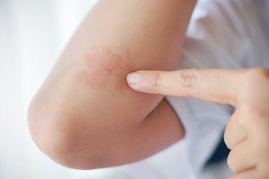 Dirseklerinde akut sedef hastalığı olan Asyalı bir kadının yakın çekimi. Otoimmün, tedavisi olmayan dermatolojik deri hastalığı. Dirseklerinde büyük kırmızı, iltihaplı, pullu bir kızarıklık. Cilt sedef iltihabı..
