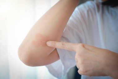 Dirseklerinde akut sedef hastalığı olan Asyalı bir kadının yakın çekimi. Otoimmün, tedavisi olmayan dermatolojik deri hastalığı. Dirseklerinde büyük kırmızı, iltihaplı, pullu bir kızarıklık. Cilt sedef iltihabı..