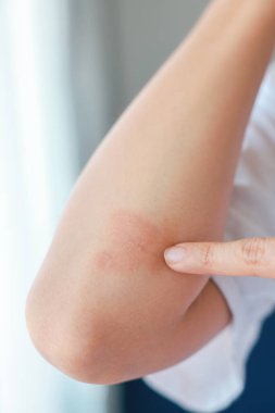 Dirseklerinde akut sedef hastalığı olan Asyalı bir kadının yakın çekimi. Otoimmün, tedavisi olmayan dermatolojik deri hastalığı. Dirseklerinde büyük kırmızı, iltihaplı, pullu bir kızarıklık. Cilt sedef iltihabı..