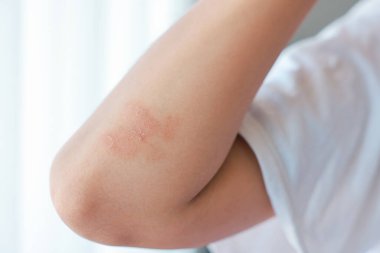 Dirseklerinde akut sedef hastalığı olan Asyalı bir kadının yakın çekimi. Otoimmün, tedavisi olmayan dermatolojik deri hastalığı. Dirseklerinde büyük kırmızı, iltihaplı, pullu bir kızarıklık. Cilt sedef iltihabı..