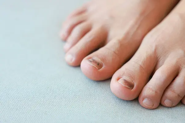 stock image Subungual Hematoma on toenail are injuries of wearing shoes that are too tight in which bleeding develops under the nail. A crush injury to the distal phalanx fingernail or toenail, black toenail.