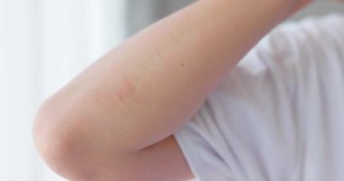 Dirseklerinde akut sedef hastalığı olan Asyalı bir kadının yakın çekimi. Otoimmün, tedavisi olmayan dermatolojik deri hastalığı. Dirseklerinde büyük kırmızı, iltihaplı, pullu bir kızarıklık. Cildinde sedef hastalığı var. 4k VDO.