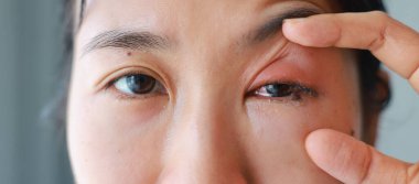 Gözlerini şiddetle ovuşturduktan sonra kadının gözleri iltihaplanır. Göze giren böcekler korneada tahriş ve yaralara neden olur, bu da gözün şişmesine ve kızarmasına neden olur. Oftalmolog göz enfeksiyonlarını tedavi ediyor..