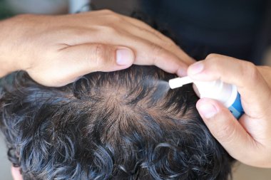Asyalı erkekler sert saçlarını korumak ve kırılmayı önlemek için serum spreyi kullanırlar. Endişeli ve kel kafasını göstermek için kafasına dokunan bir adam. Saç kökü gıdası. Sağlık, tedavi, ilaç kavramı.