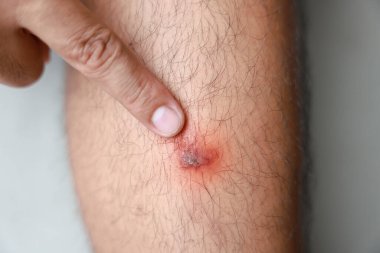 Bir adam bacağını kabalaştırıyor. Yaralardaki Papilloma virüsü semptomları şişkinliklere ve pürüzlü cilde neden olur. Sağlık hizmetleri tıbbi konsepti.