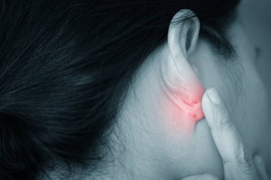 Kulağın arkasındaki deri enfeksiyonu kırmızılık, iltihap ve tahriş gösteriyor. Dermatolojik sorun, egzama ya da mantar enfeksiyonu kavramı. Tıbbi cilt sorunu.