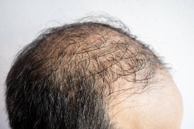 Side view of baldness men's head with thin hair on his top and forehead. Conceptual of hair problem on men's head.