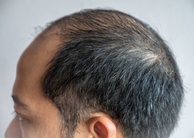 Cropped shot view of Asian male head with few grey hair growing. Hair turns white when the pigmentation cells responsible for colour (melanin) stop being produced.