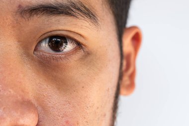 Siyah halkalar ve şişkinlik gibi göz altı sorunları olan sağlıksız Asyalı bir adama yakın durun. Kolajen hidro jel kullanarak göz altı maskesi cildin nemlenmesini sağlayabilir..