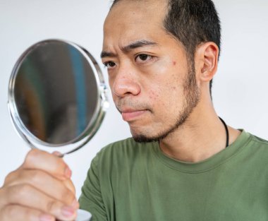 Asyalı adamın keskin nişancı görüntüsü yüzünde sivilce ya da sivilce sorununu gördü. Sivilcenin kavramsal görüntüsü ve erkek yüzünde sorun var..