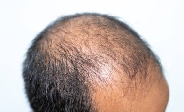 Kellerin kafa derisinin yan görüntüsü. Kellik genleriniz ve erkek seks hormonlarınızla ilgilidir. Genellikle saç çizgisinin gerilemesi ve taç üzerindeki kılların seyrelmesi şeklinde devam eder..