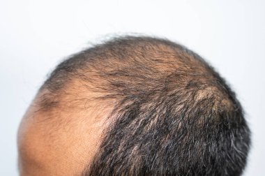 Kelliğin yan görünüşü, erkeklerin kafa derisi. Kellik genleriniz ve erkek seks hormonlarınızla ilgilidir. Genellikle saç çizgisinin gerilemesi ve taç üzerindeki kılların seyrelmesi şeklinde devam eder..