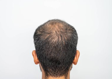 Asyalı erkeklerin saç dökülme sorunu olan kel kafalarının arka görüntüsü. Erkeklerin kafasında saç dökülme sorunu kavramı.