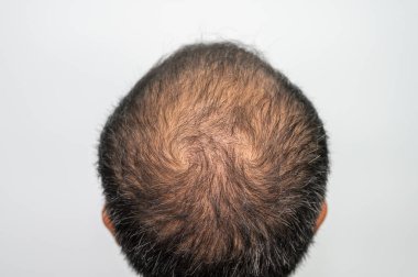 İnce saçlı ve gri saçlı Asyalı erkeklerin kel kafalarının arka görüntüsü. Erkeklerin kafasındaki saç problemi kavramı.