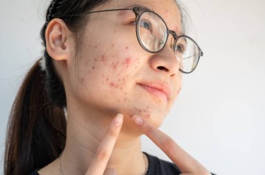 Suratında akne iltihabı (Papule ve Pustule) sorunu olan mutsuz Asyalı kadının görüntüsü. Kadın tenindeki sorunların kavramı.