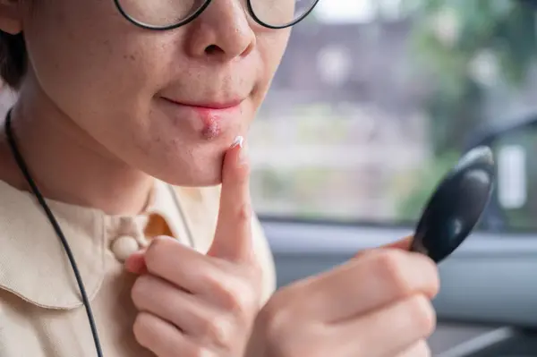 stock image Close up of woman applying cream for treat Herpes simplex virus and reduce the risk of transmitting the virus to others. Herpes simplex virus is an infection that causes herpes.