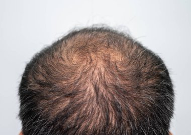 İnce saçlı ve gri saçlı Asyalı erkeklerin kel noktalarını kapatın. Erkeklerin kafasındaki saç problemi kavramı.